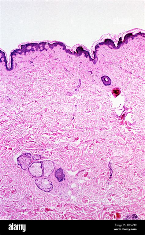 Microscopic view of a skin tumor edge