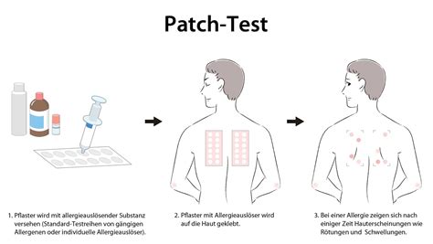 Illustration of patch testing procedure