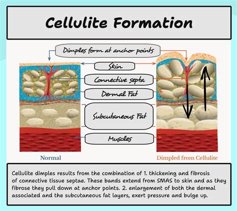 Diagram showing how laser treatment targets fibrous bands beneath the skin to reduce cellulite.