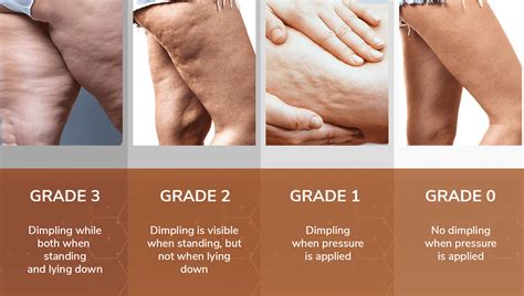Comparison table of various cellulite treatments, detailing effectiveness, downtime, cost, and ideal candidates.