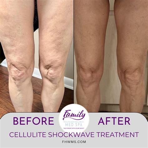 Collage of before-and-after images from various cellulite treatments.