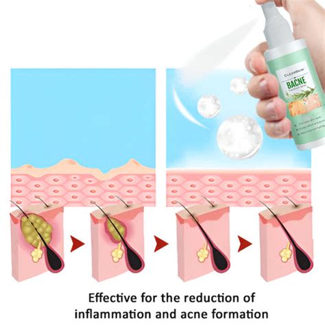 Infographic showing the steps for applying bacne spray