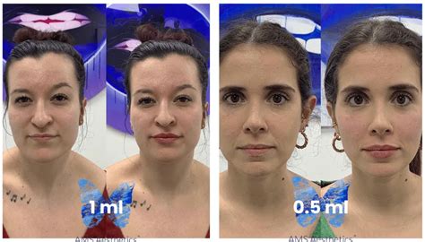 Infographic showing the difference in lip volume achieved with 0.5ml, 1ml, and 2ml of lip filler.