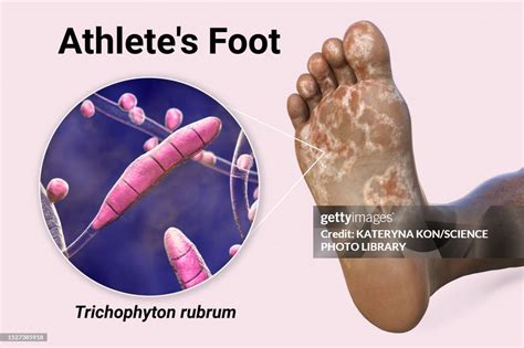 Illustration of athlete's foot fungus
