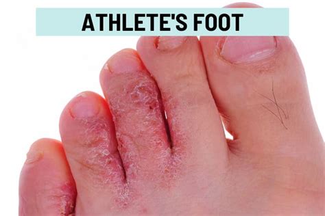 Close-up image showing symptoms of athlete's foot: redness, peeling, and cracking skin between toes