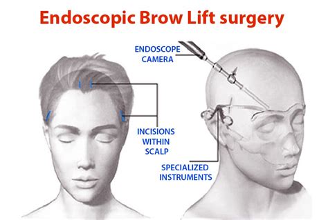 Diagram illustrating the endoscopic brow lift procedure, showing small incisions and the endoscope.
