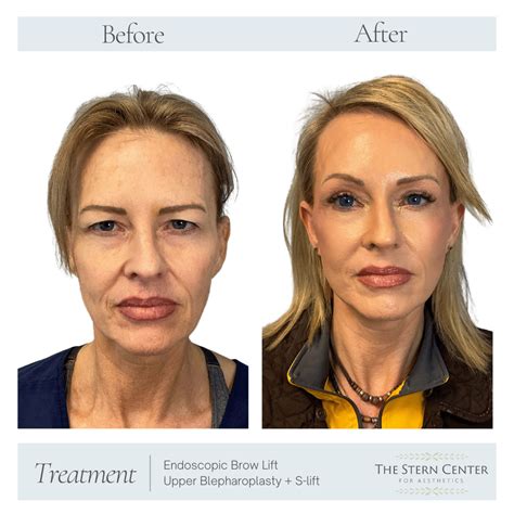 Before and after photos of an endoscopic brow lift, showcasing reduced forehead wrinkles and lifted eyebrows.