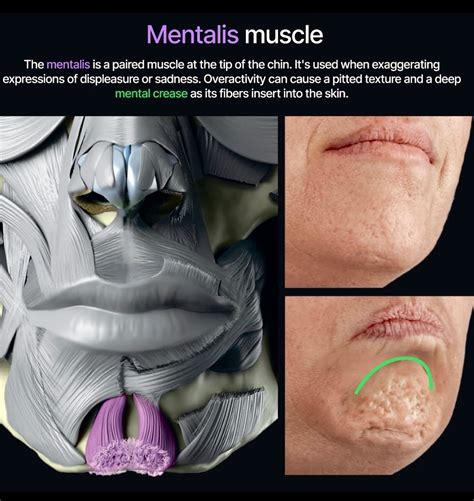 Illustration showing the mentalis muscle in the chin area and potential injection points.