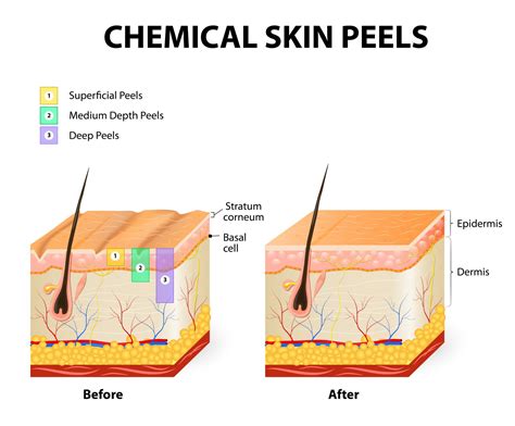 Diagram showing different layers of skin and how chemical peels affect them.