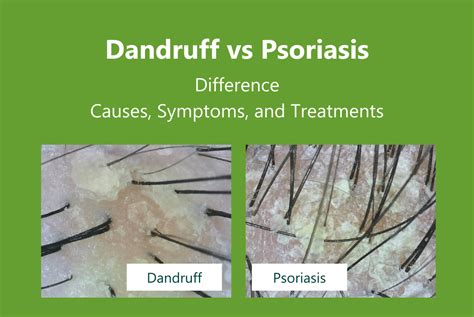 Infographic illustrating how coal tar works on scalp conditions like psoriasis and dandruff.