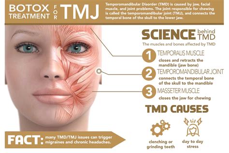 Infographic showing the effects of Botox on jaw muscles for TMJ relief.