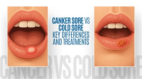 Illustration comparing cold sores and canker sores, highlighting external vs. internal location and cause.