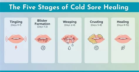 Infographic illustrating the stages of a cold sore outbreak, from tingling to healing.