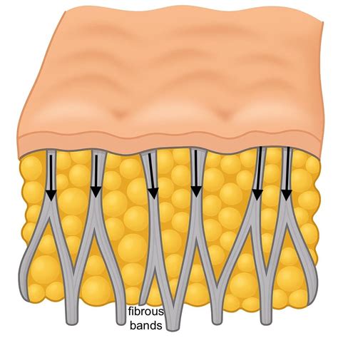 Diagram illustrating the structure of cellulite, showing fibrous bands tethering skin to muscle with fat cells in between.