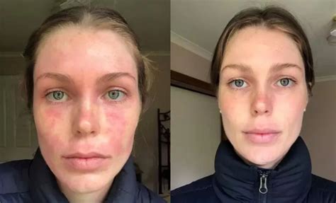 Before and after photos showing eczema improvement after using beef tallow