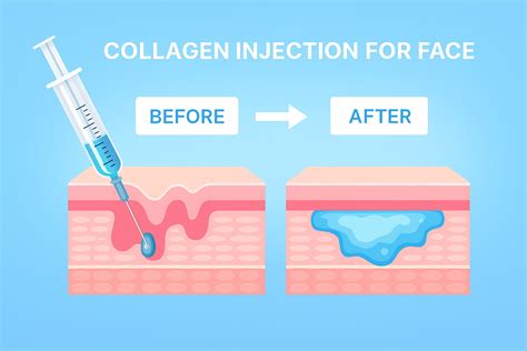 Image comparing collagen supplements and collagen injections, perhaps showing a timeline of results.