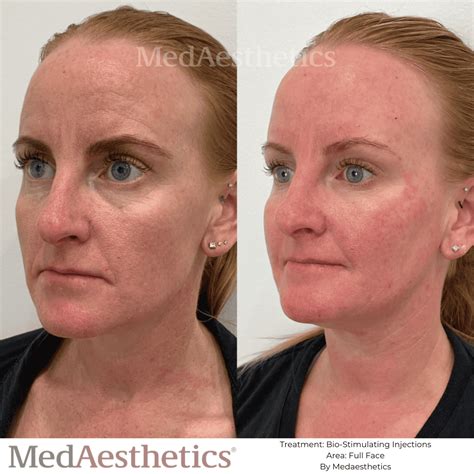 Comparison table of various non-surgical skin rejuvenation treatments, including collagen injections, supplements, and ultrasound therapy, detailing cost, downtime, and expected results.