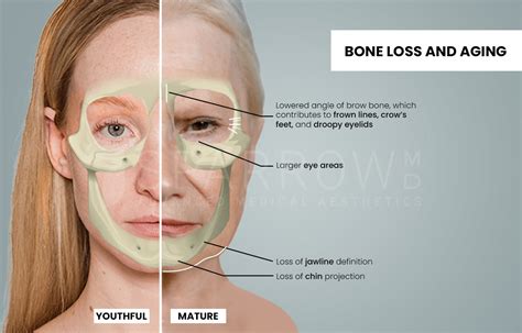 Infographic showing areas of facial volume loss with aging