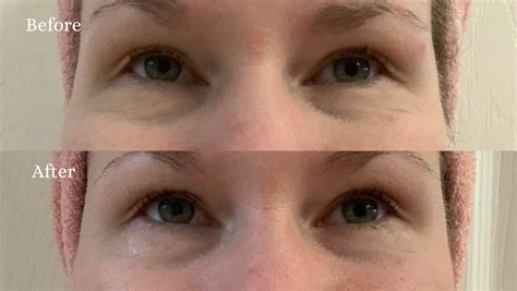 Before and after images showcasing the Line Blurring Wrinkle Filler's effect on fine lines