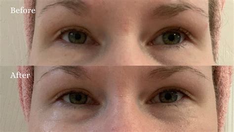 Before and after images illustrating the Lid Lifting Treatment's impact on the eye area