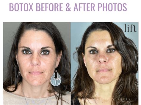 Collage of before-and-after photos showcasing results from common cosmetic dermatology procedures like Botox and laser treatments.