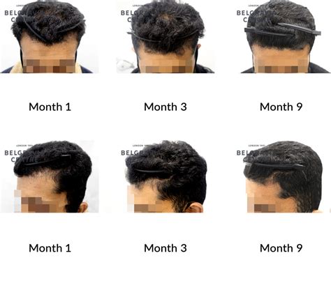 Comparison chart showing hair growth results after 8 weeks for Babe Original Hair Serum and The Ordinary's Multi-Peptide Serum.