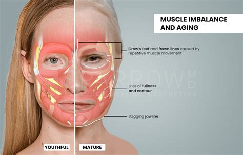 Diagram illustrating the effect of Botox on facial muscles to reduce wrinkles.