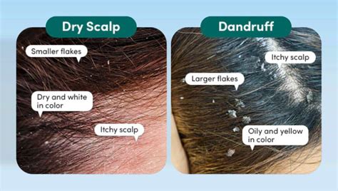 Diagram illustrating the structure of a healthy scalp versus a dry or irritated scalp, highlighting areas where Grahams Natural Scalp Relief Shampoo's ingredients would act.