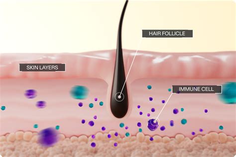 Illustration of a hair follicle under attack by immune cells