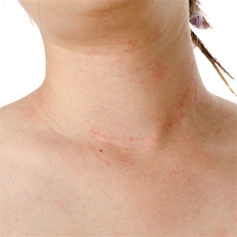 Illustration of eczema patches on the neck