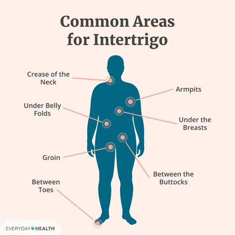 Infographic illustrating areas prone to intertrigo