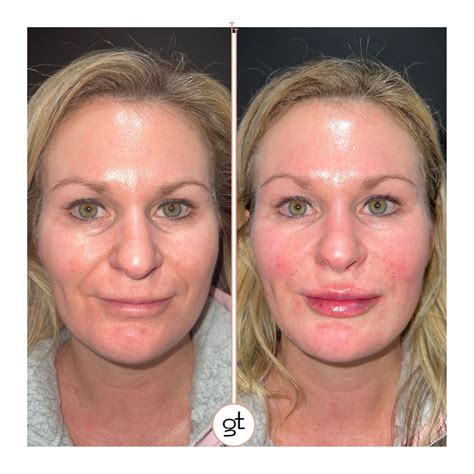 Before and after images demonstrating the effects of Botox and dermal fillers.