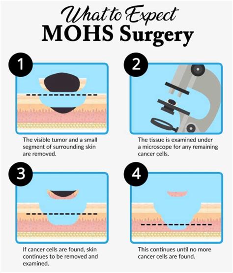Illustration of Mohs surgery procedure