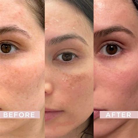 Before and after photos of chemical peel results