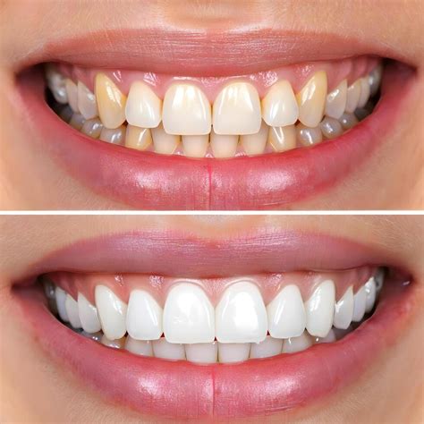 Before and after comparison showing teeth whitening results after 4 days of using Crest 3DWhite Daily Whitening Serum