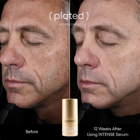 Split image showcasing the author's cheek before and after 30 days of using Plated Intense Serum, highlighting scar reduction.