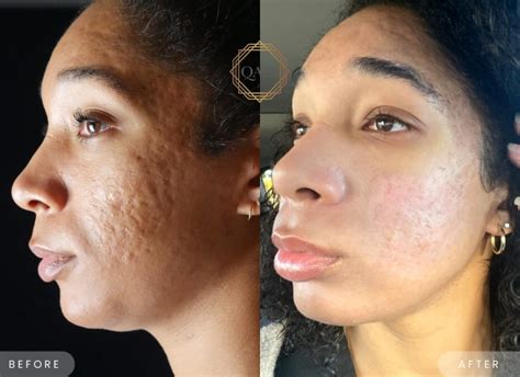 Before and after images illustrating the reduction of acne scars and hyperpigmentation with glycolic acid treatment