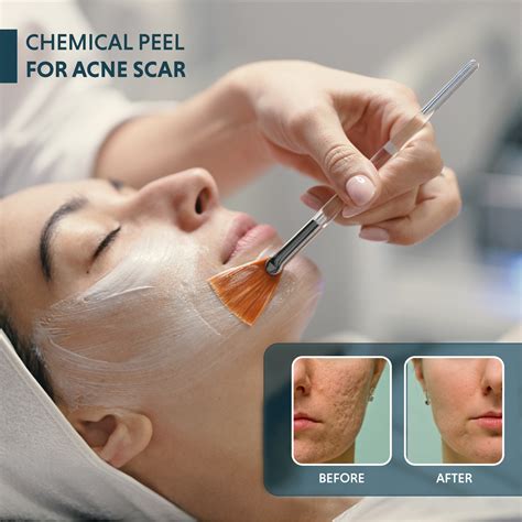 Close-up photo of a skincare professional applying a chemical peel solution to a patient's face with a brush.