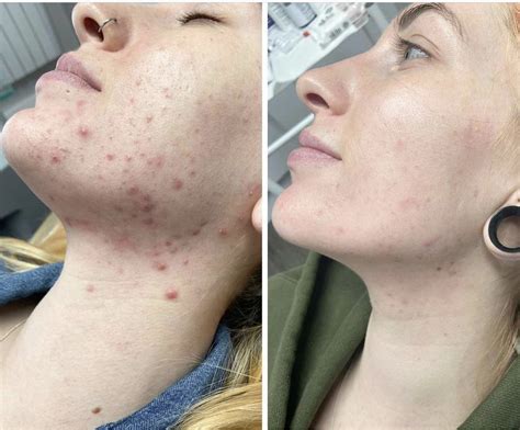 Collage of before-and-after photos from user reviews of TCA body peels, showcasing improved skin texture and reduced acne.
