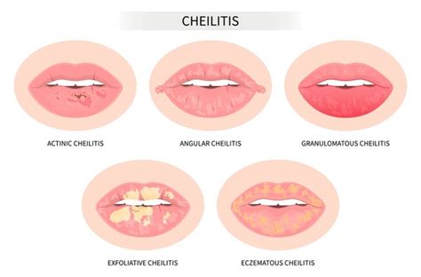 Illustration of lip irritation caused by allergic reactions
