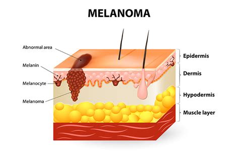 Diagram illustrating the spread of melanoma to the leptomeninges