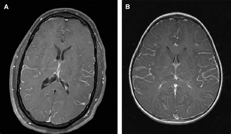 MRI scan showing leptomeningeal enhancement