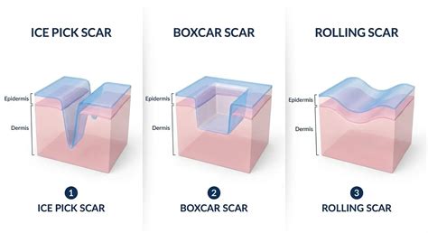Diagram illustrating the cross-section of an ice pick scar compared to other atrophic scar types.