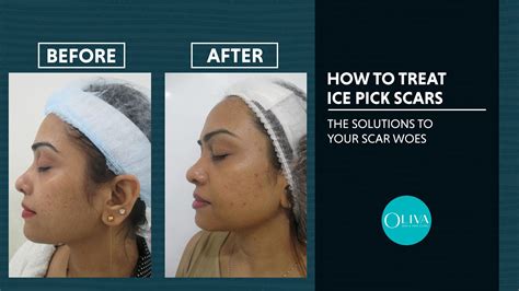 Collage of images showing before and after results of different ice pick scar treatments.