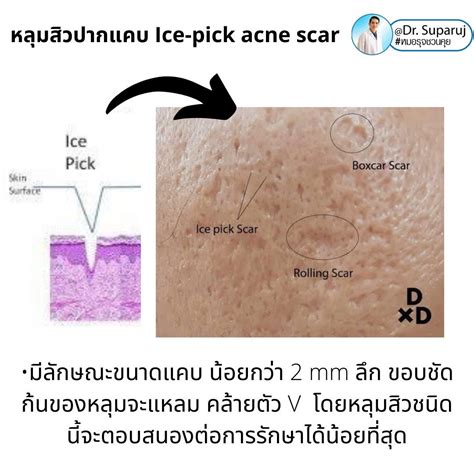 Infographic comparing the effectiveness and recovery times of various ice pick scar treatments.