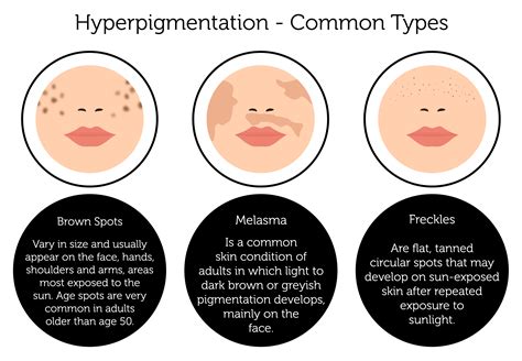 Illustration comparing different types of hyperpigmentation on various skin tones.