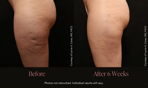 Before and after images demonstrating the temporary reduction in cellulite appearance after using a caffeinated cream.