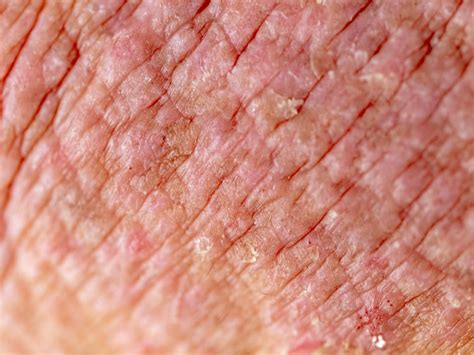 Close-up image of skin affected by atopic dermatitis, showing redness and dryness.