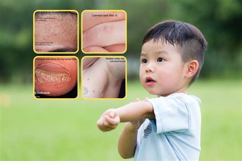 Illustration of common viral skin infections in children