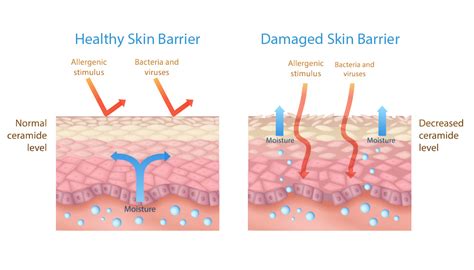 Illustration showing a healthy skin barrier versus a compromised skin barrier in eczema.